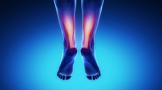 Achilles Tendon Injury