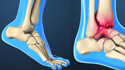 Ankle & Foot Arthritis